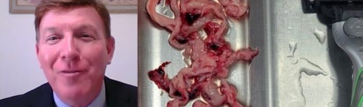 Vláknité biele zrazeniny lekári teraz vyťahajú už aj z tiel žijúcich obetí covidových vakcín (VIDEO nevhodné pre citlivé povahy!)