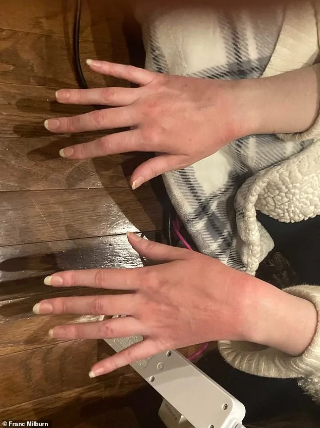 Milburn shared a picture which he claims shows Eskridge's hands burned and discolored after allegedly being struck by an 'energy weapon'
