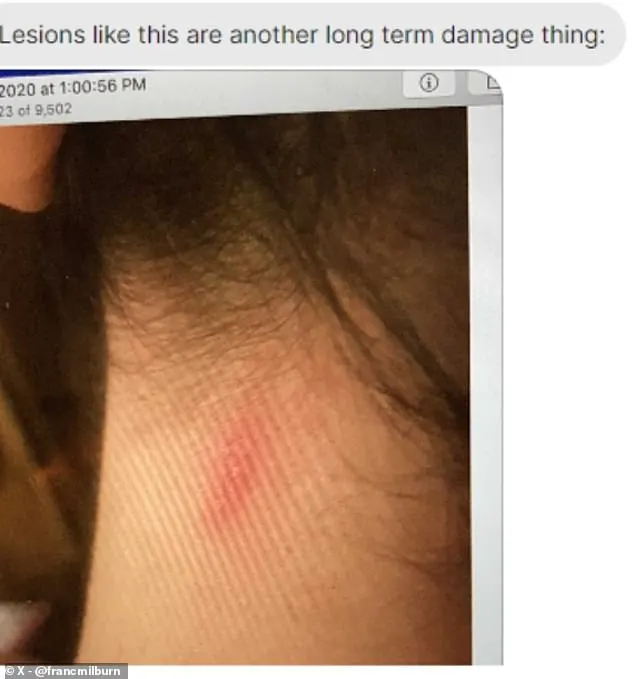 Lesions also developed after Eskridge claimed she had been struck by a directed energy weapon