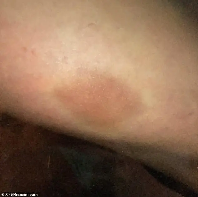 Eskridge revealed the alleged attacks also caused burns filled with fluid under her skin