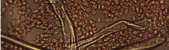 The EXPOSE: Dr. Philippe van Welbergen: Grafen se uvolňuje z očkovaných COVID-19 na neočkované a tvoří smrtící krevní sraženiny (video)