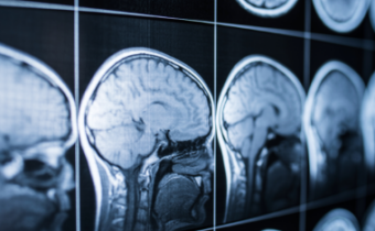 Diagnóza "mozgovej smrti" znehodnocuje ľudský život a robí nás zraniteľnými voči neetickej liečbe