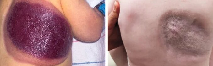 Lékaři bijí na poplach kvůli nárůstu prudkého kolapsu imunitního systému po nových vakcínách proti covidu