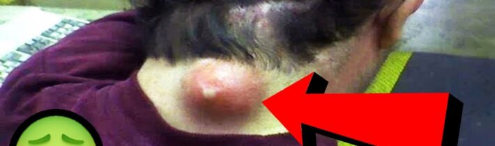 TOP 5 Uspokojivá videa z vymačkávání pupínků